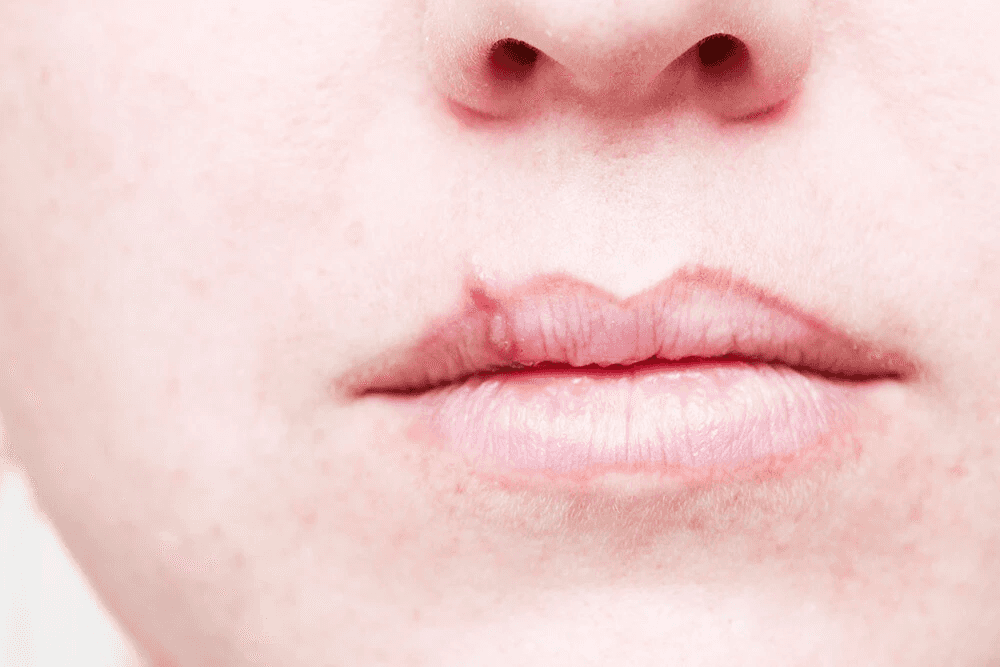 Cold sore on lip