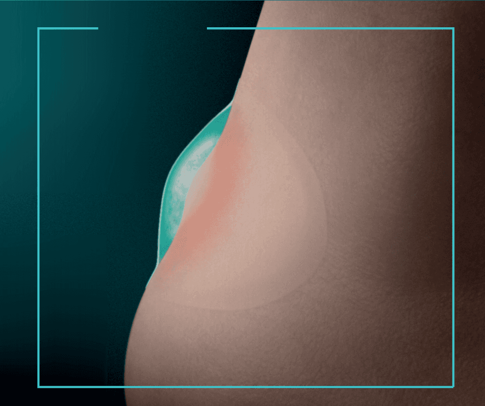 illustration of blister plaster on blister